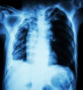Pulmonary Tuberculosis . Chest X-Ray : Right lung atelectasis Royalty Free Stock Photo