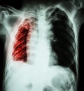 Pulmonary Tuberculosis . Chest X-Ray : Right lung atelectasis and infiltration and effusion due to Mycobacterium Tuberculosis i Royalty Free Stock Photo