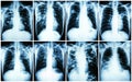 Pulmonary Tuberculosis Collection . Chest X-ray : show patchy infiltration , interstitial infiltration , alveolar infiltration , Royalty Free Stock Photo