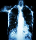 Pulmonary Tuberculosis