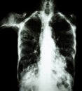 Pulmonary Tuberculosis ( film chest x-ray : interstitial infiltrate both lung due to Mycobacterium tuberculosis infection )