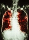 Pulmonary Tuberculosis . film chest x-ray of old patient show interstitial infiltration both lung and calcification at trachea c Royalty Free Stock Photo