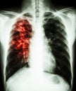 Pulmonary tuberculosis Royalty Free Stock Photo