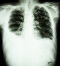 Pulmonary Tuberculosis