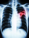 Pulmonary Tuberculosis Royalty Free Stock Photo