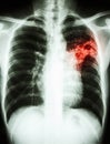 Pulmonary Tuberculosis Royalty Free Stock Photo