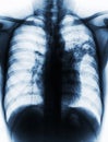 Pulmonary Tuberculosis . Film chest x-ray show alveolar infiltrate at left middle lung due to Mycobacterium tuberculosis infection