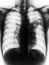 Pulmonary Tuberculosis . Film chest x-ray show alveolar infiltrate at left middle lung due to Mycobacterium tuberculosis infection