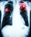 Pulmonary Tuberculosis Royalty Free Stock Photo