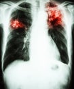 Pulmonary Tuberculosis Royalty Free Stock Photo