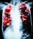 Pulmonary Tuberculosis