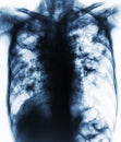 Pulmonary Tuberculosis . Film chest x-ray show fibrosis,cavity,interstitial infiltration both lung due to Mycobacterium tuberculos