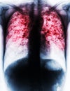 Pulmonary Tuberculosis .