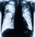 Pulmonary Tuberculosis .