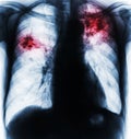 Pulmonary Tuberculosis .