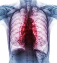 Pulmonary Tuberculosis . Film chest x-ray show interstitial infiltrate both lung due to Mycobacterium tuberculosis infection Royalty Free Stock Photo