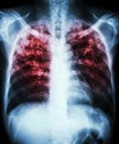 Pulmonary tuberculosis