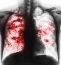 Pulmonary tuberculosis . Film x-ray of chest show cavity at right lung and interstitial infiltrate both lung due to TB infection Royalty Free Stock Photo