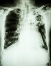 Pulmonary tuberculosis Royalty Free Stock Photo