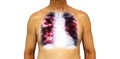 Pulmonary tuberculosis . Human chest with x-ray show cavity at right upper lung and interstitial infiltrate both lung due to infec