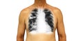 Pulmonary tuberculosis . Human chest with x-ray show cavity at right upper lung and interstitial infiltrate both lung due to infec Royalty Free Stock Photo