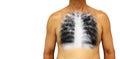 Pulmonary tuberculosis . Human chest with x-ray show interstitial infiltrate both lung due to infection . Isolated background . Bl Royalty Free Stock Photo