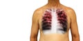 Pulmonary tuberculosis . Human chest with x-ray show interstitial infiltrate both lung due to infection . Isolated background . Bl Royalty Free Stock Photo