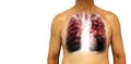 Pulmonary tuberculosis . Human chest with x-ray show interstitial infiltrate both lung due to infection . Isolated background . Bl Royalty Free Stock Photo