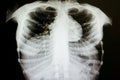 pulmonary tuberculosis