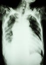 Pulmonary tuberculosis and right lung effusion