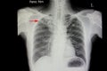 pulmonary tuberculosis in right upper lung