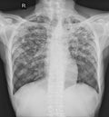 Pulmonary Tuberculosis TB : Chest x-ray Royalty Free Stock Photo