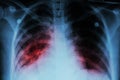 Pulmonary Tuberculosis ( TB ) : Chest x-ray show alveolar infiltration at both lung due to mycobacterium tuberculosis infection Royalty Free Stock Photo