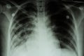 Pulmonary Tuberculosis ( TB ) : Chest x-ray show alveolar infiltration at both lung due to mycobacterium tuberculosis infection Royalty Free Stock Photo