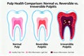 Pulp Health Comparison Normal Reversible and Irreversible Pulpitis Explained Royalty Free Stock Photo
