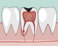 A pulpitis of a molar or periodontitis of the tooth with inflammation as a concept of toothache, a flat vector stock illustration