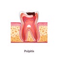 Pulpitis Realistic Illustration Royalty Free Stock Photo