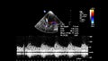 Pulse Wave Doppler Ultrasound Examination.