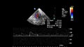 Pulse Wave Doppler Ultrasound Examination.