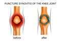 Puncture synovitis of the knee joint Royalty Free Stock Photo