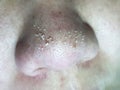Purulent acne in the nose. Selective focus