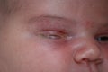 The purulent eye processed by tetracycline ointment Conjunctivitis, treatment of the newborn