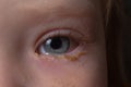 Purulent inflammation of the eyes, conjunctivitis in the eyes of a caucasian child