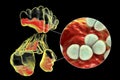 Purulent inflammation of frontal, maxillary, and ethmoid sinuses and close-up view of pneumococci bacteria