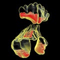 Purulent inflammation of frontal, maxillary, and ethmoid sinuses, close-up view