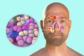 Purulent inflammation of frontal and maxillary sinuses and close-up view of staphylococcal bacteria