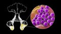 Purulent inflammation of maxillary sinuses and close-up view of bacteria Staphylococcus aureus that cause sinusitis