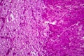 Purulent meningitis, light micrograph