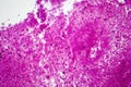 Purulent meningitis, light micrograph