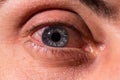 Pus arises from an infected eye. Near Royalty Free Stock Photo